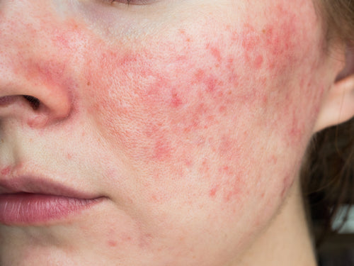 Do I Have Rosacea or Just Red Cheeks?